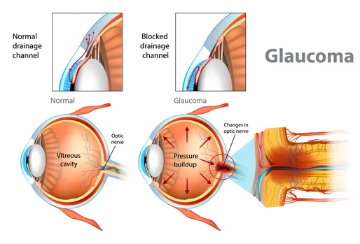 Glaucoma