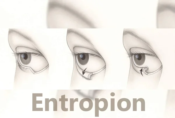 Entropian